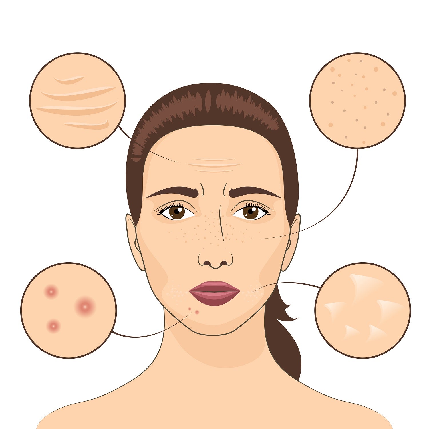 Why Adult Acne Is Becoming More Prevalent and How to Treat It